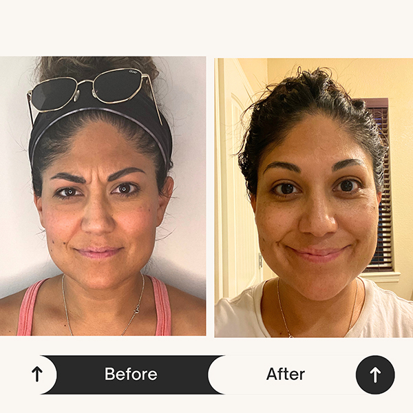 Botox before and after at ZK Aesthetics