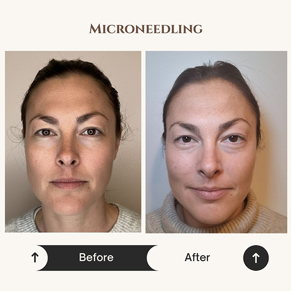 Microneedling before and after at ZK Aesthetics