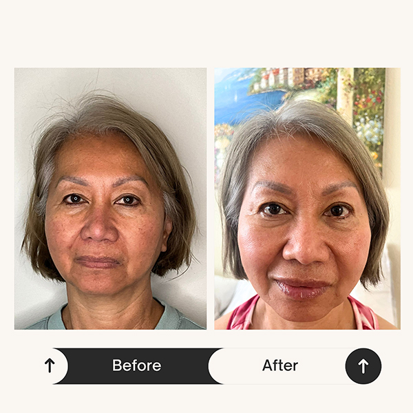 Dermal filler before and after results at ZK Aesthetics Sacramento