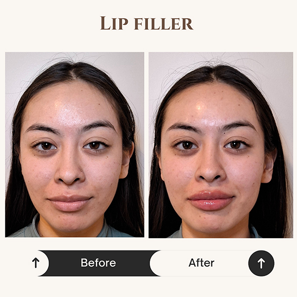 Lip filler before and after results at ZK Aesthetics Sacramento